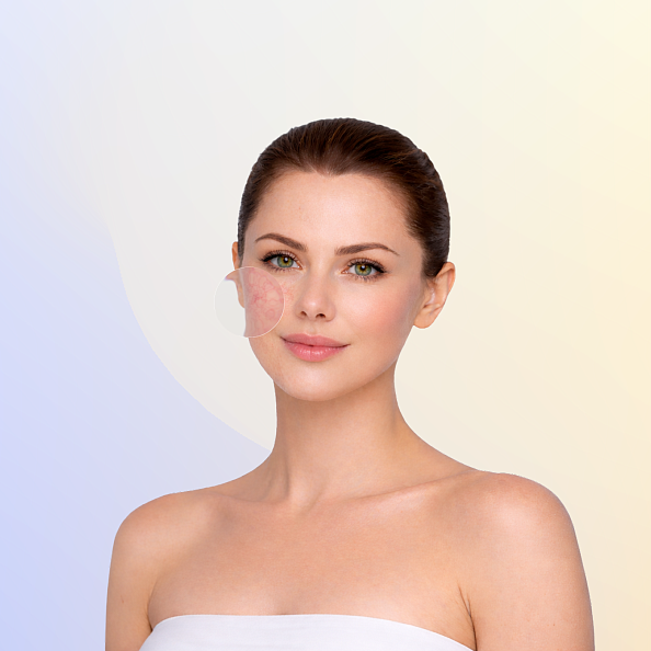 Удаление сосудов на лице и теле